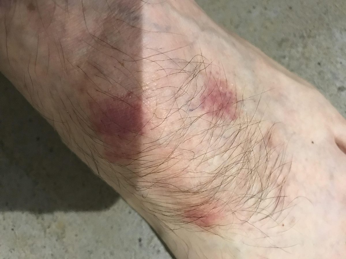 A photo of sensitised skin on the foot of an installer.